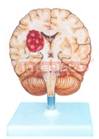 HUMAN BRAIN STROKE MODEL